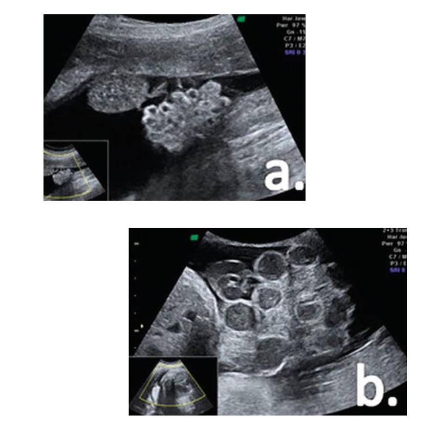 Antenatally Diagnosed Conditions Abdominal Wall Defects