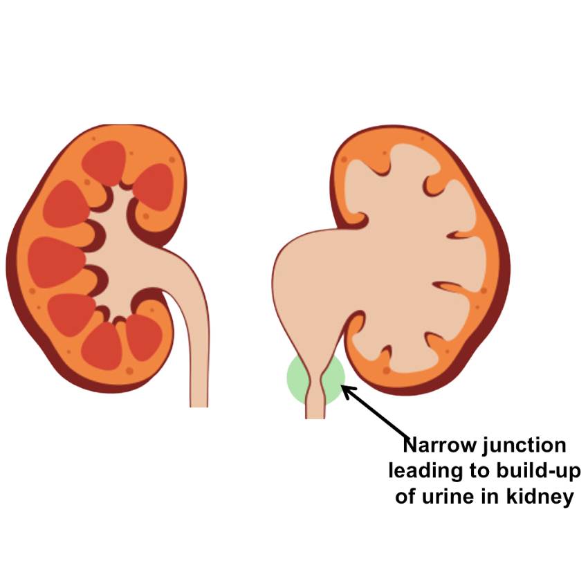 Antenatally Diagnosed Conditions Kidney Hydronephrosis