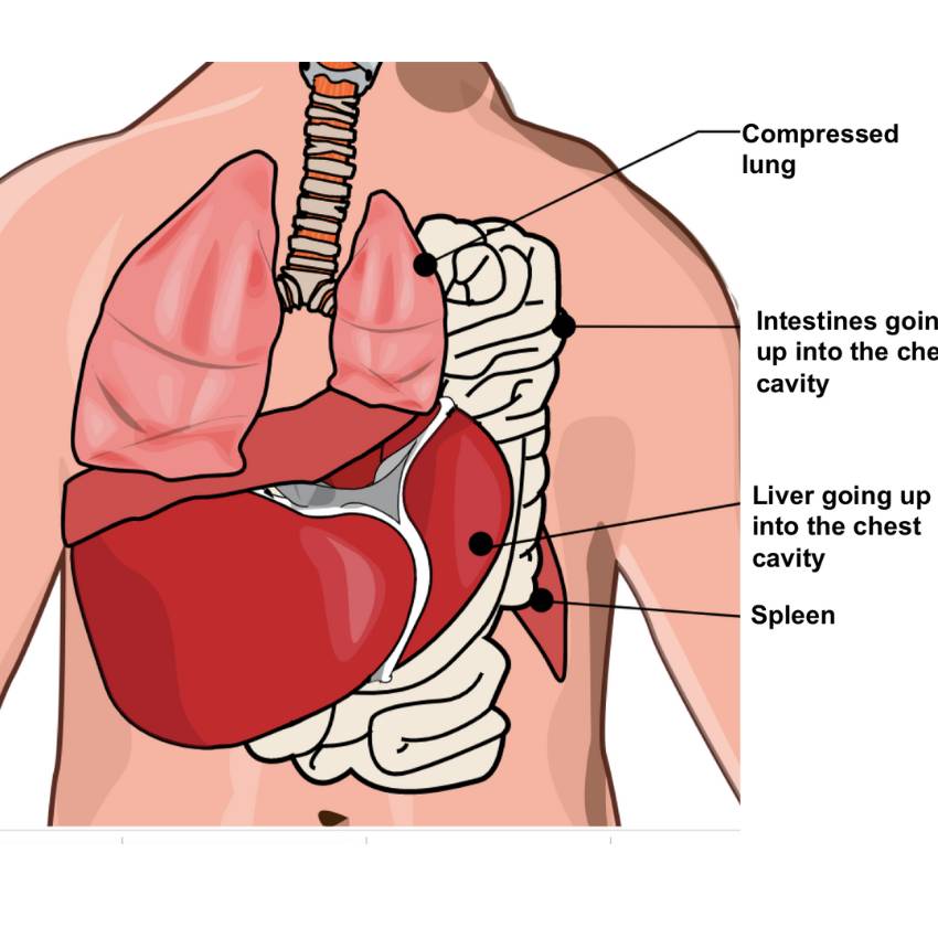 Congenital Diaphragmatic Hernia CDH image