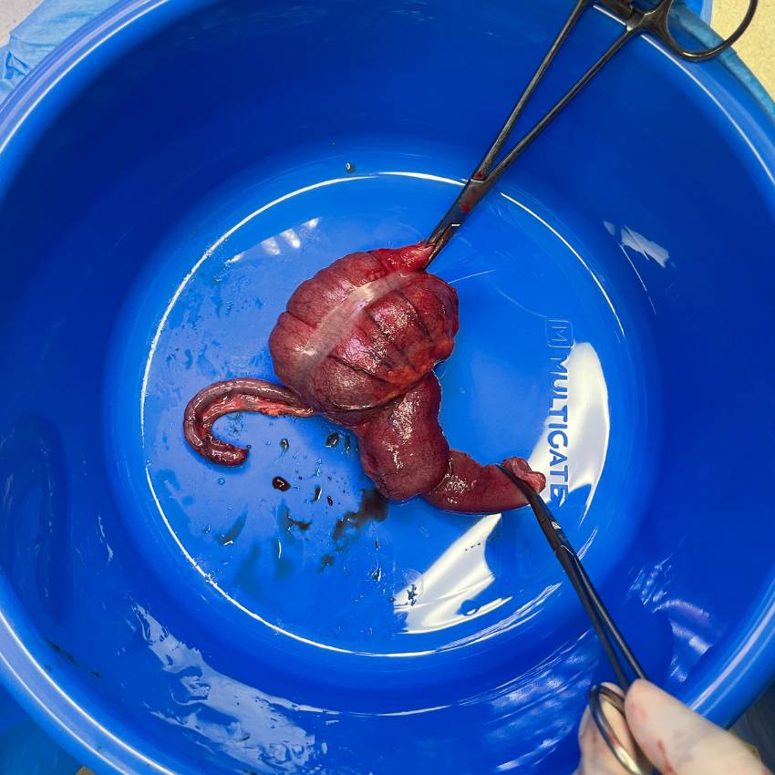 GI intussusception