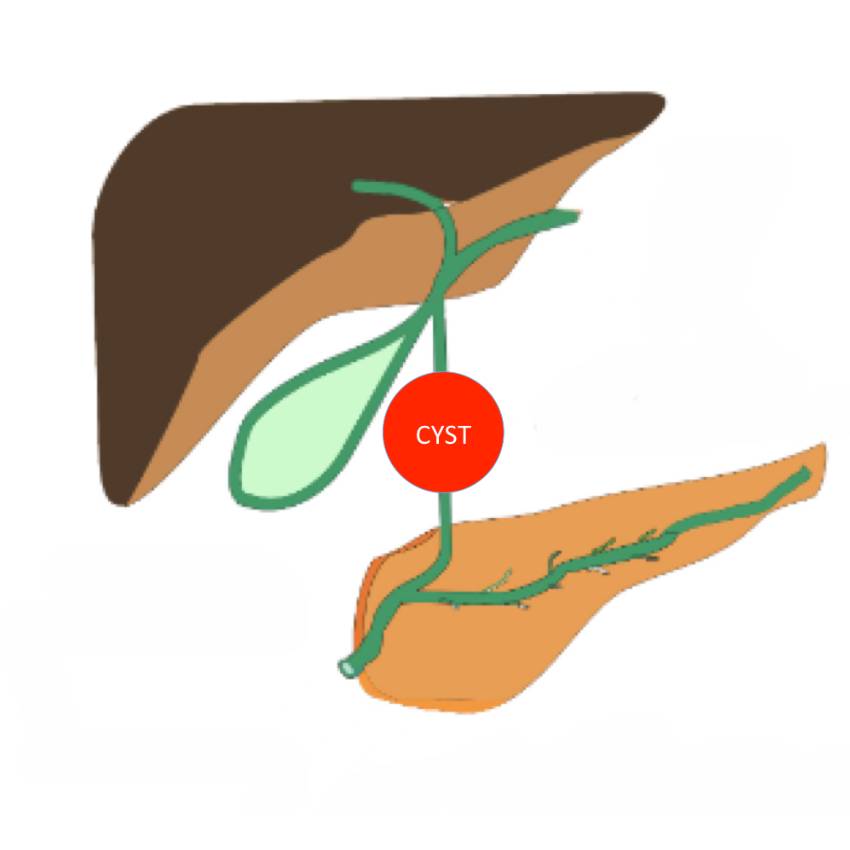 Hepatobiliary Surgery Choledochal Cyst