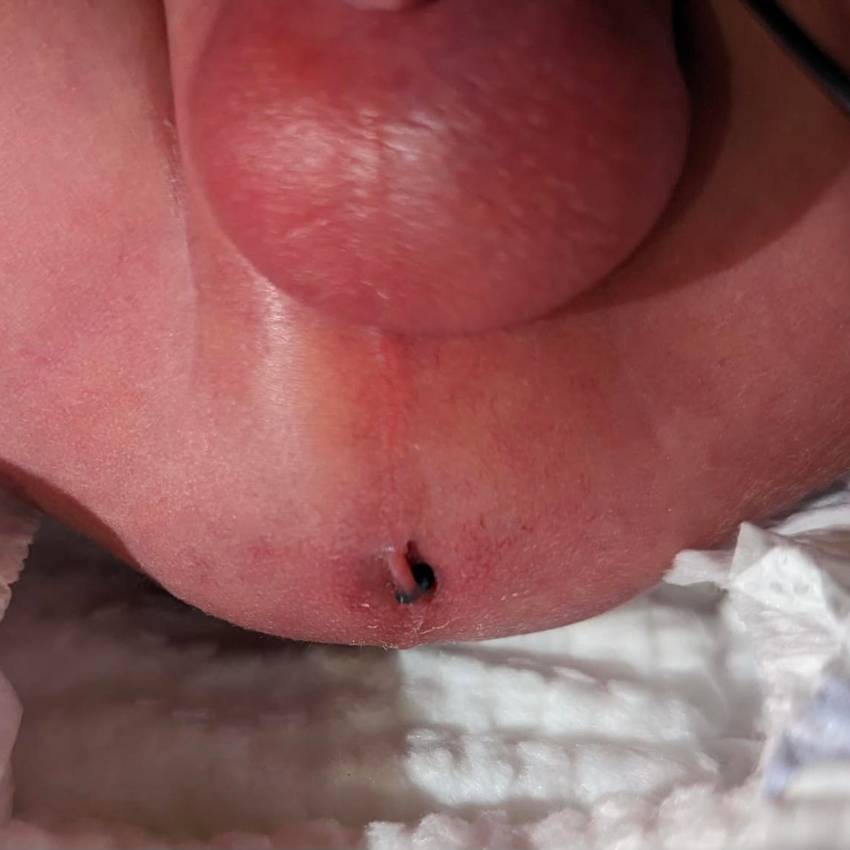 Neonatal Surgery Anorectal Malformation   Absent Anus