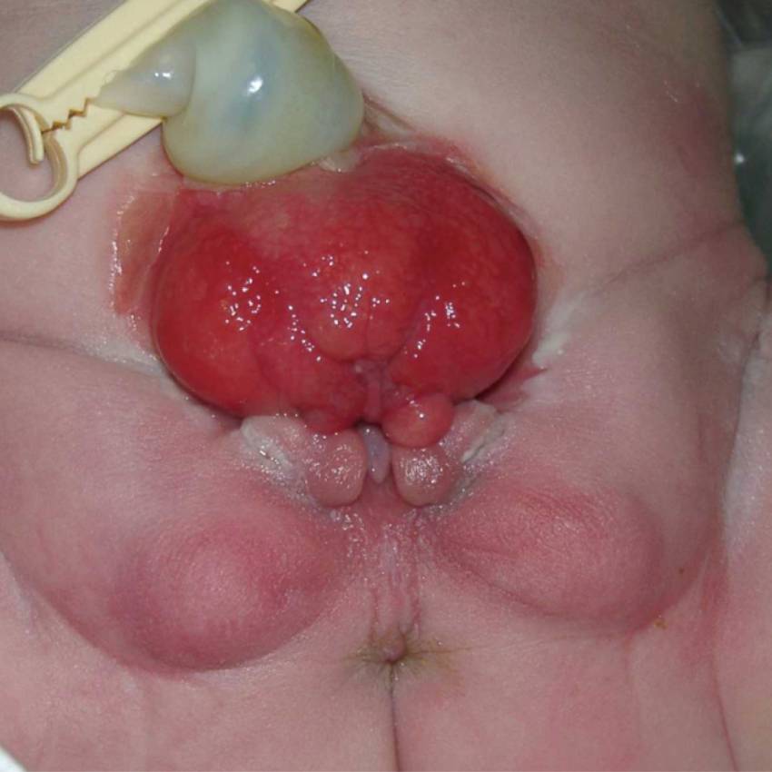 Neonatal Surgery Bladder Exstrophy