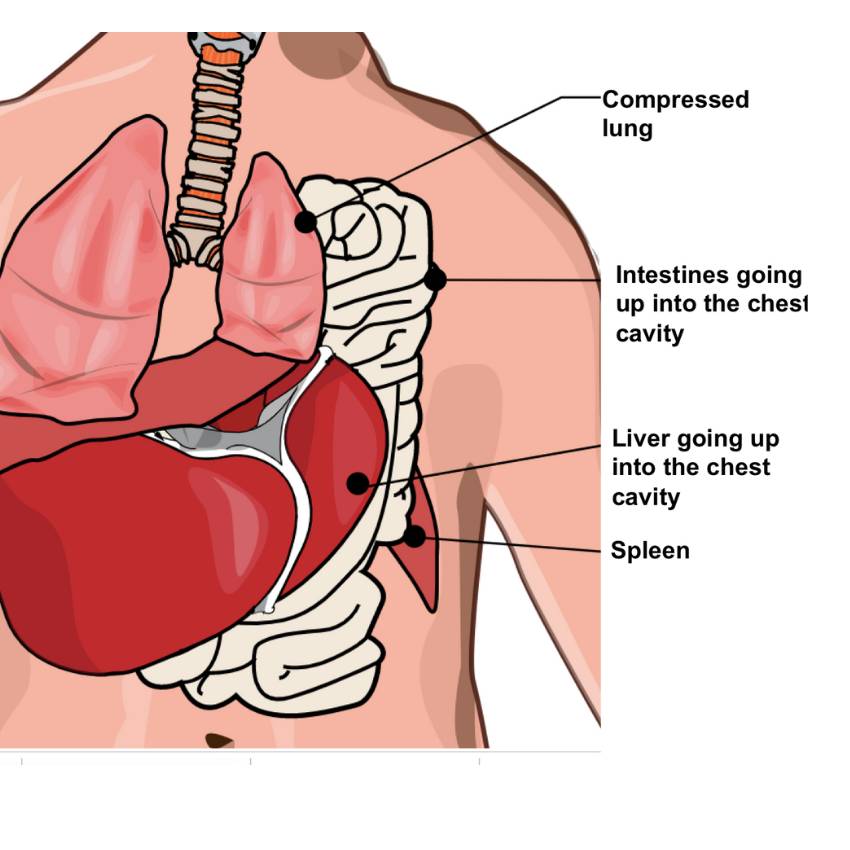 Neonatal Surgery Congenital Intestinal Anomalies 2