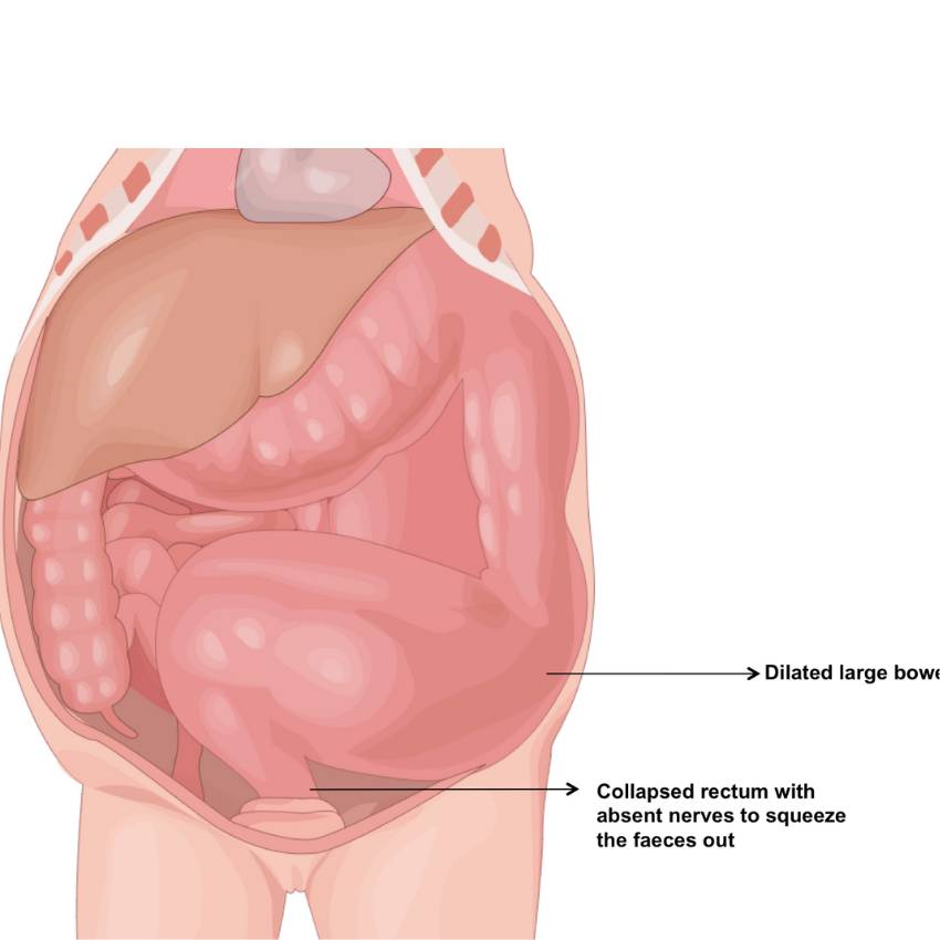 Neonatal Surgery Hirschsprungs Disease