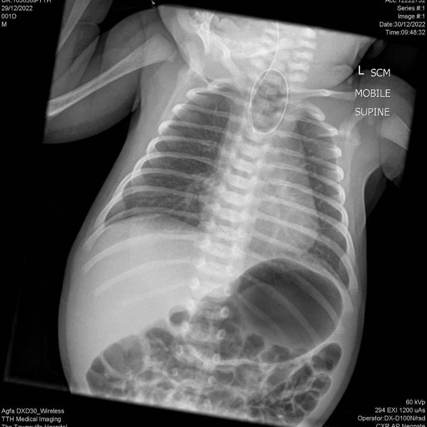 Neonatal Surgery Oesophageal Atresia   Tracheo Oesophageal Fistula
