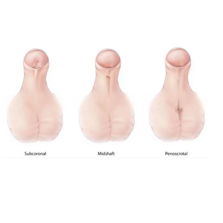 Paediatric Urology Hypospadias