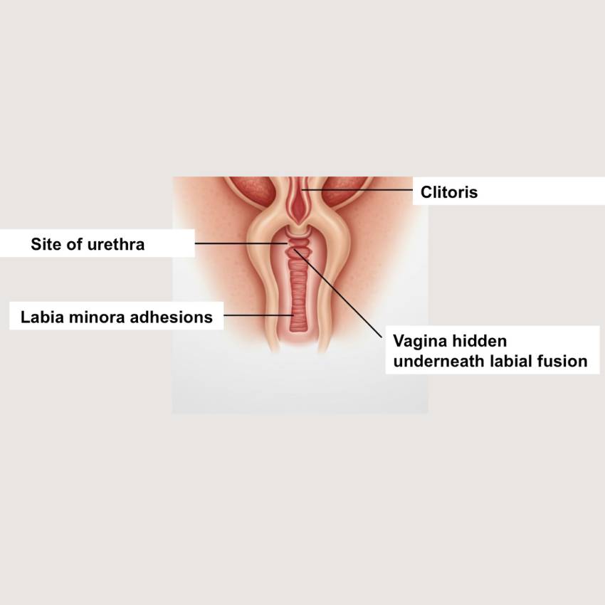 Paediatric Urology Labial Adhesions
