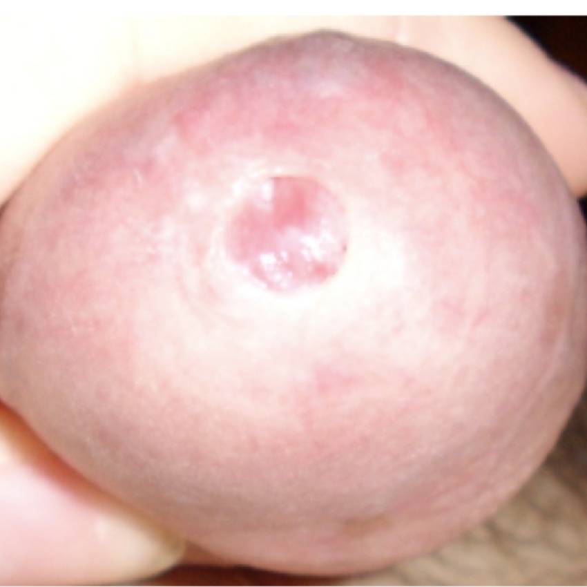 Paediatric Urology Phimosis   Circumcision