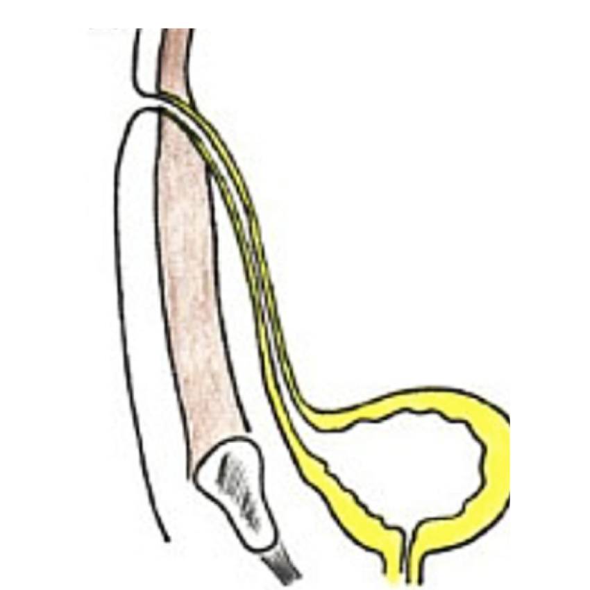 Paediatric Urology Urachal Anomalies