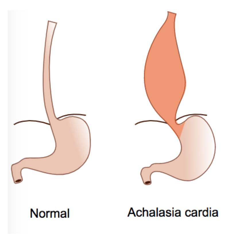 Upper GI Achalasia Cardia