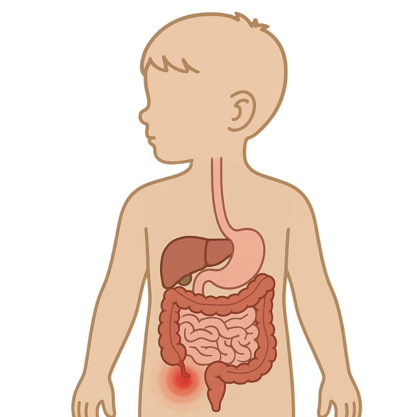 Upper GI Appendicitis