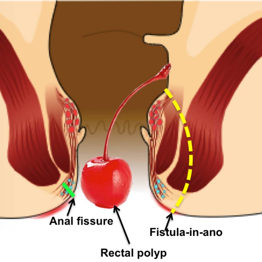 Upper GI Minor anorectal conditionsrectal polyp