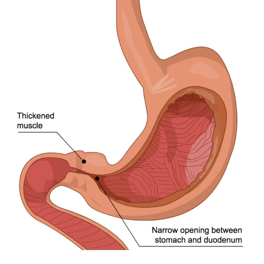 Upper GI Pyloric Stenosis