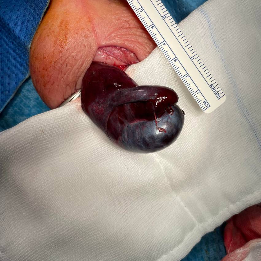 Urology Testicular Torsion